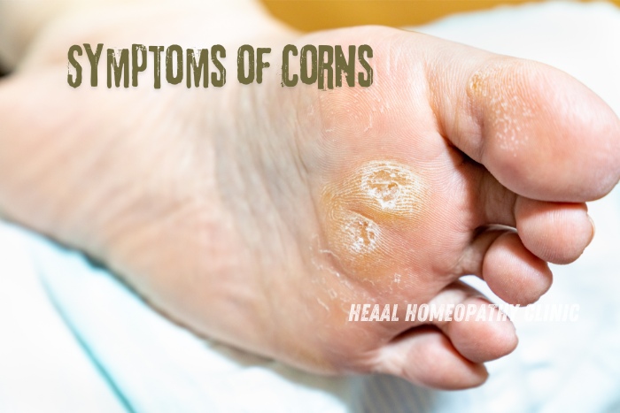 Close-up of a foot showing the symptoms of corns, a condition effectively treated at HEAAL Homeopathy Clinic in Chanda Nagar, Hyderabad