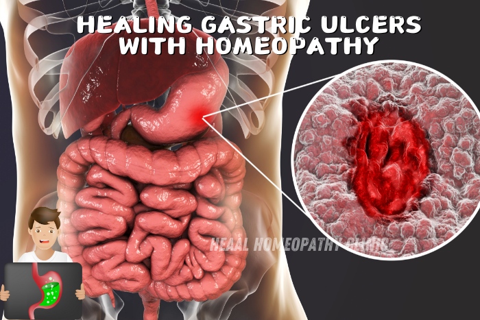 Healing gastric ulcers with homeopathy - a holistic treatment approach available at HEAAL Homeopathy Clinic, Chanda Nagar, Hyderabad