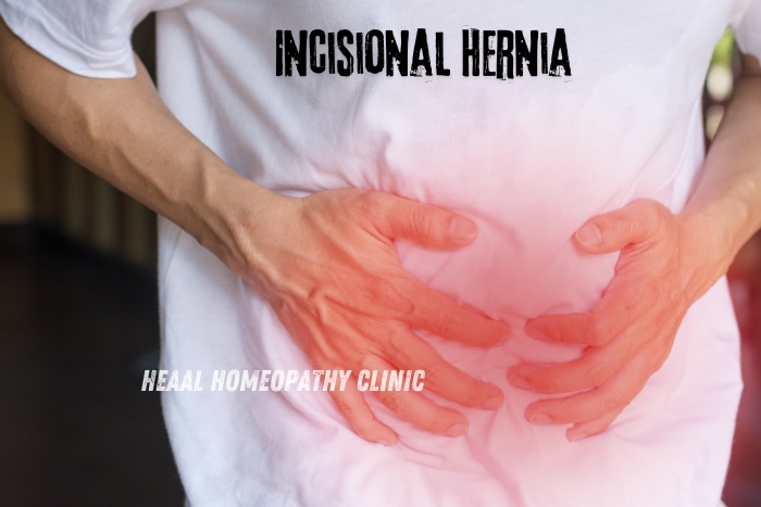 Incisional hernia treatment using homeopathy at HEAAL Homeopathy Clinic, Chanda Nagar, Hyderabad, offering natural and effective solutions for hernia relief