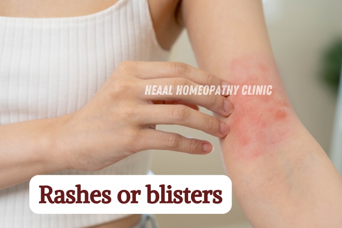 Natural remedies for skin allergies and rashes by HEAAL Homeopathy Clinic in Chanda Nagar, Hyderabad